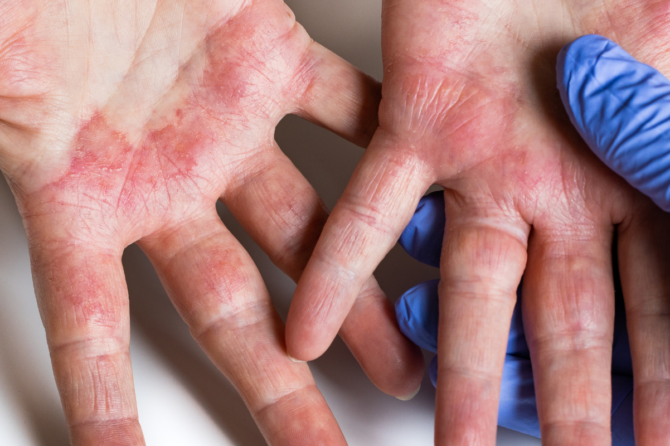 Understanding Dermatitis: 4 Types, Symptoms, & Treatment