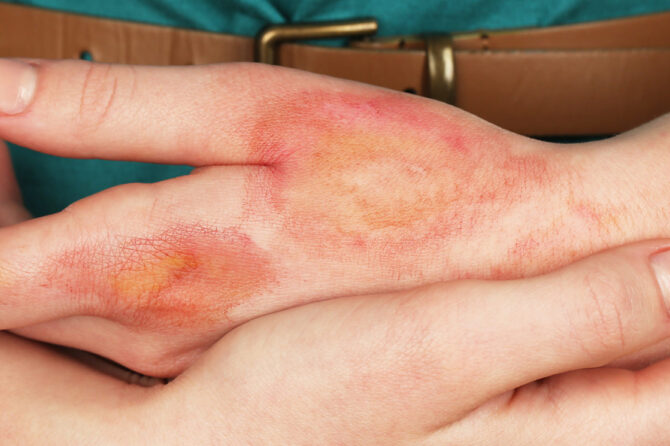 How to Treat a Minor Burn at Home