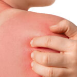 Urgent Care Sunburn Treatment: When to Seek Help