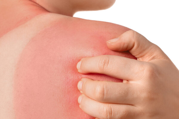Urgent Care Sunburn Treatment: When to Seek Help